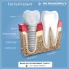 Best Dental Implant Clinic