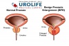 Flexible Ureteroscopy